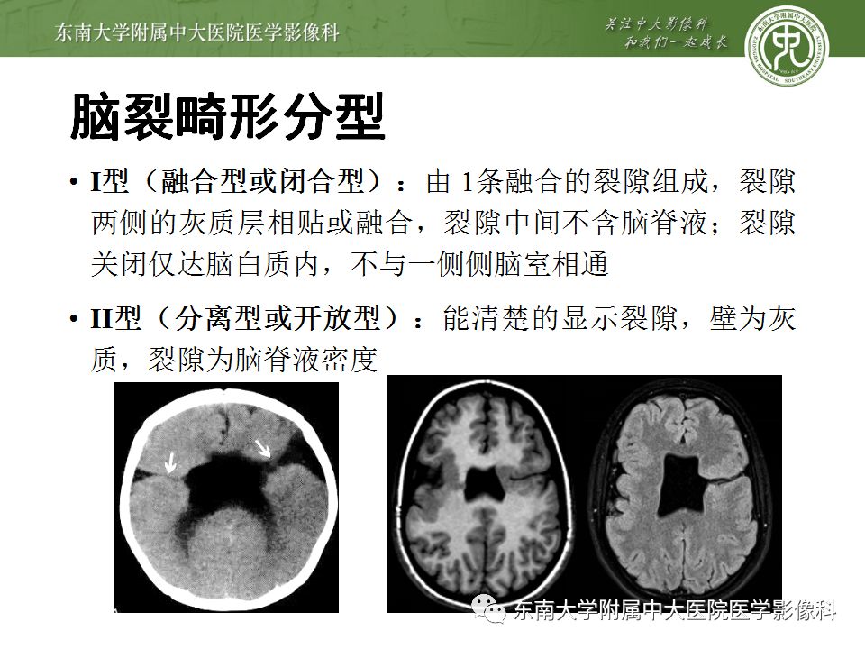 【病例】分离型脑裂畸形、脑灰质异位、透明隔缺如、胼胝体发育不良1例MR