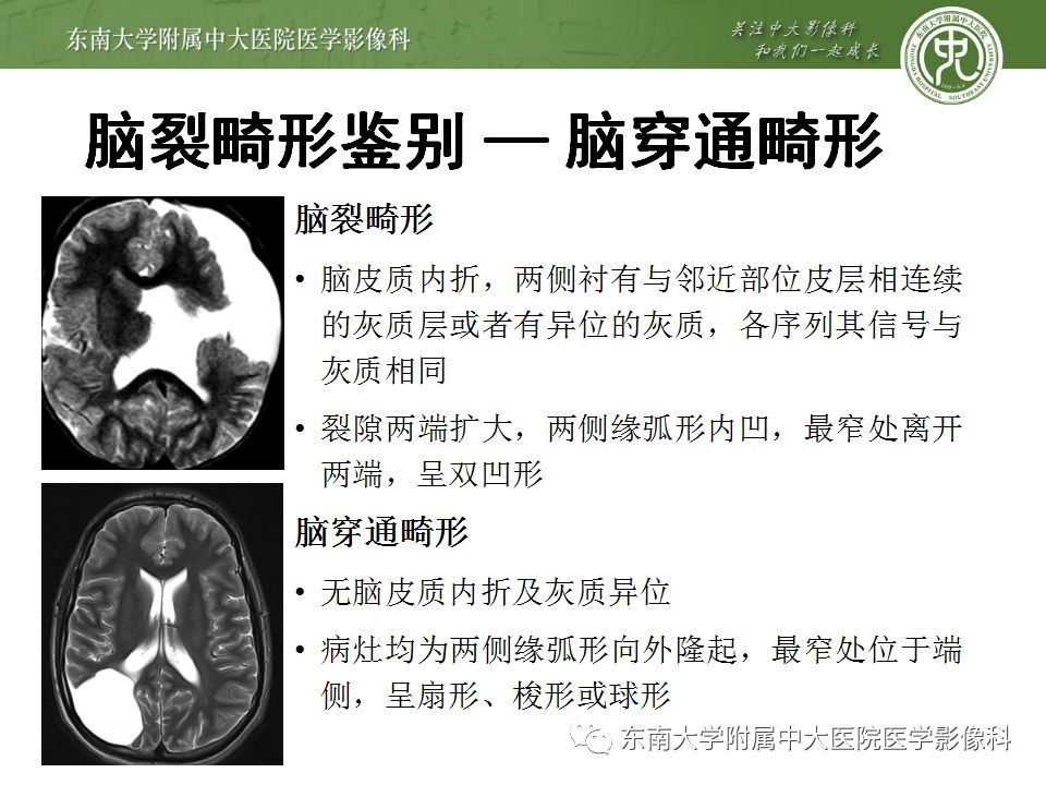 【病例】分离型脑裂畸形、脑灰质异位、透明隔缺如、胼胝体发育不良1例MR