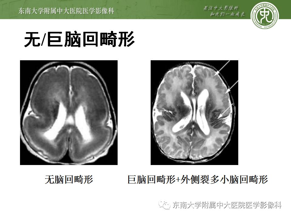 【病例】分离型脑裂畸形、脑灰质异位、透明隔缺如、胼胝体发育不良1例MR