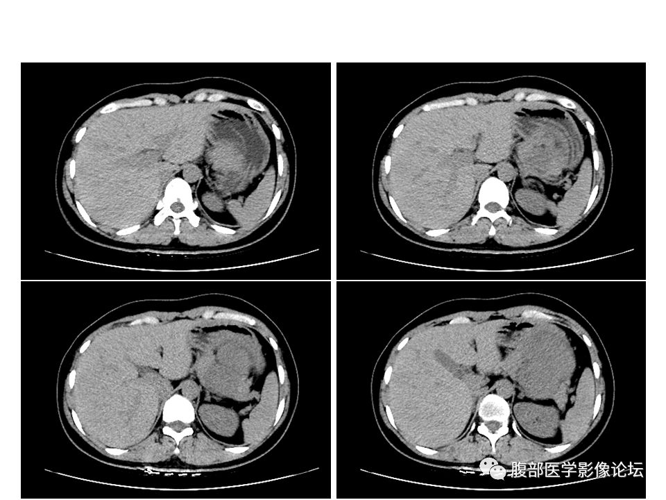 【病例】腹腔副神经节瘤1例CT