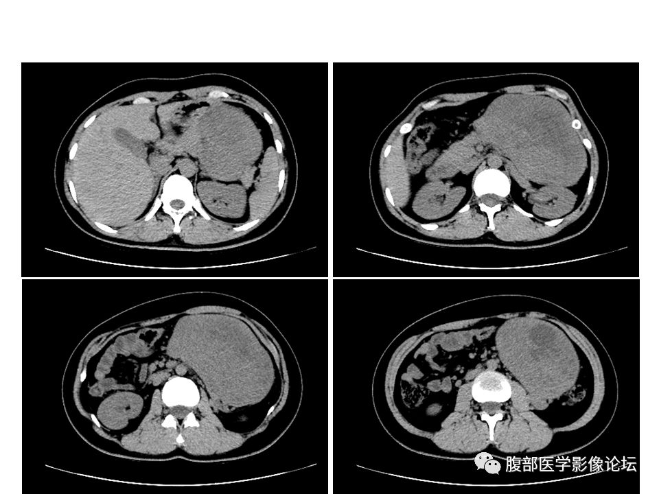 【病例】腹腔副神经节瘤1例CT
