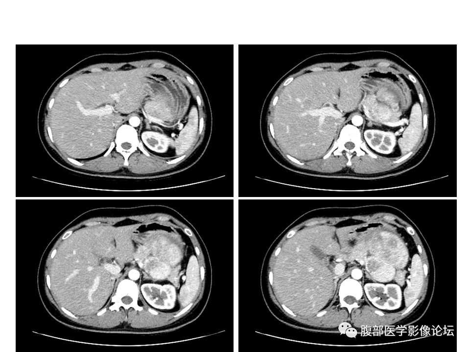 【病例】腹腔副神经节瘤1例CT