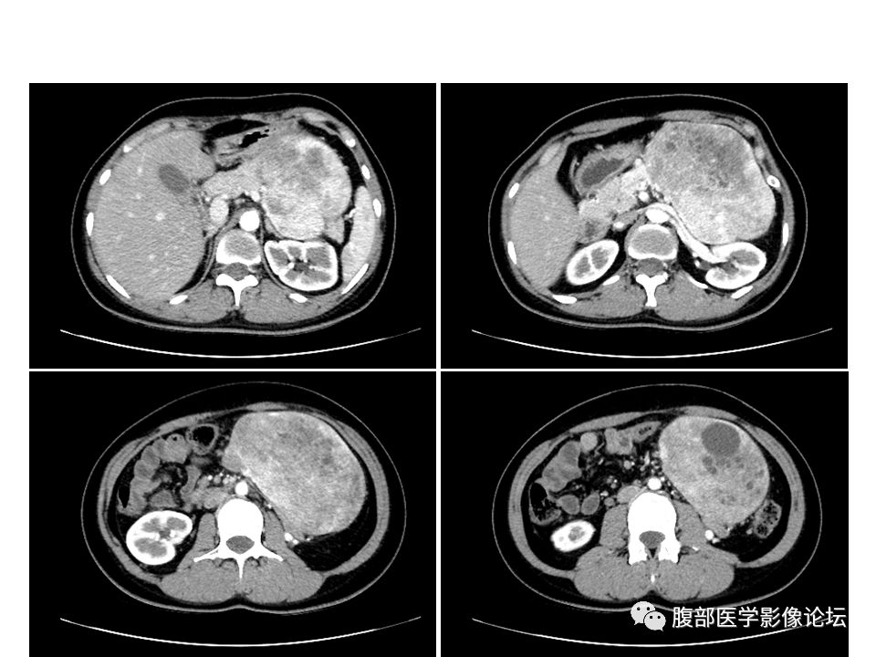 【病例】腹腔副神经节瘤1例CT