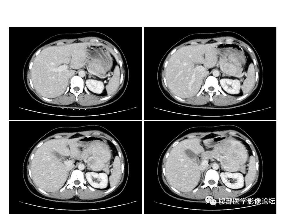 【病例】腹腔副神经节瘤1例CT