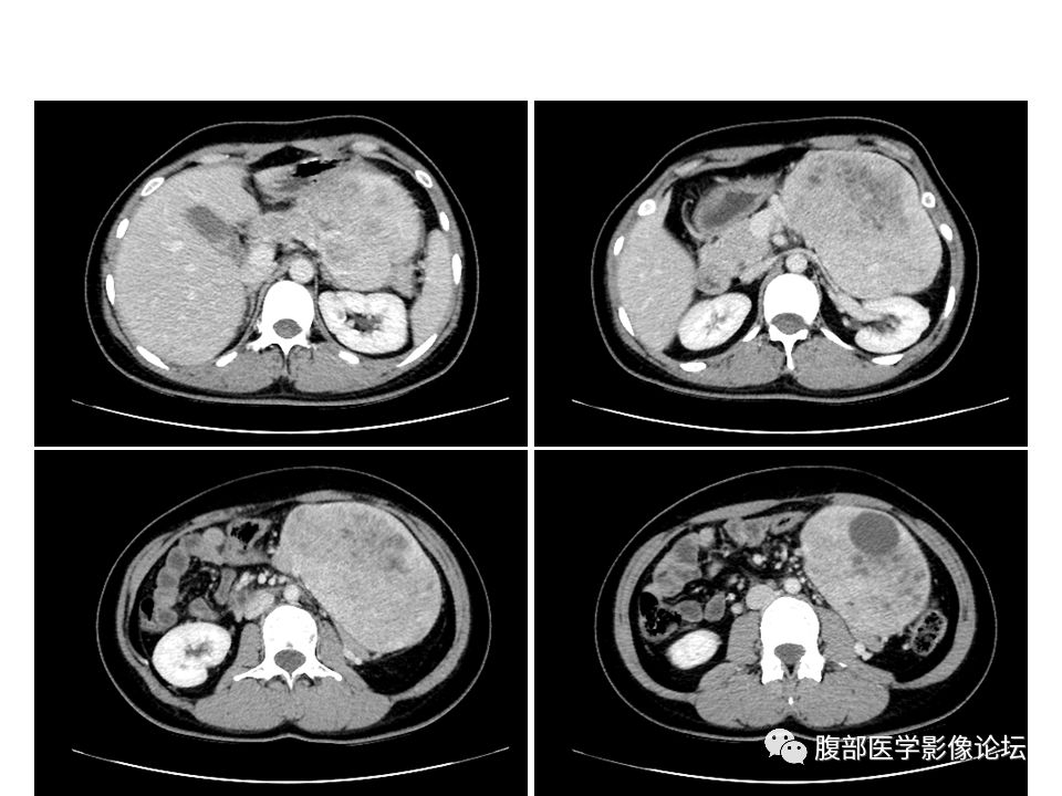 【病例】腹腔副神经节瘤1例CT