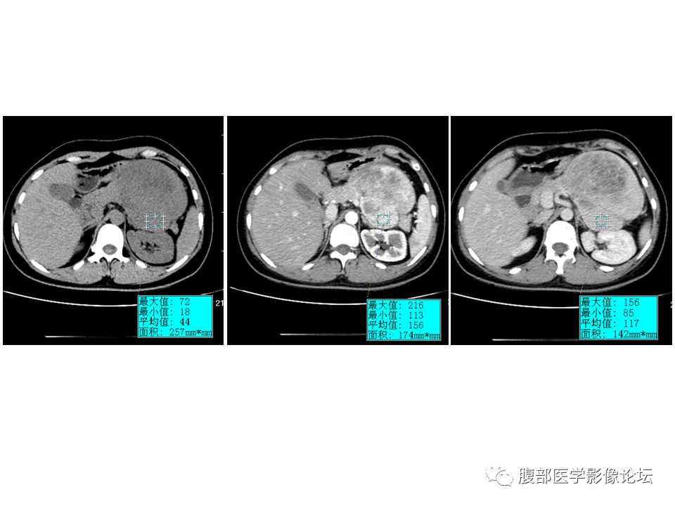 【病例】腹腔副神经节瘤1例CT