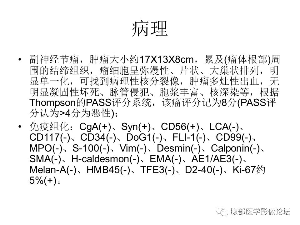 【病例】腹腔副神经节瘤1例CT