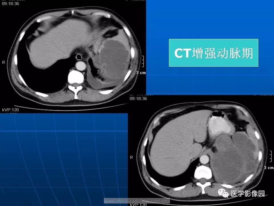 【病例】脾脏血管肉瘤1例CT影像表现