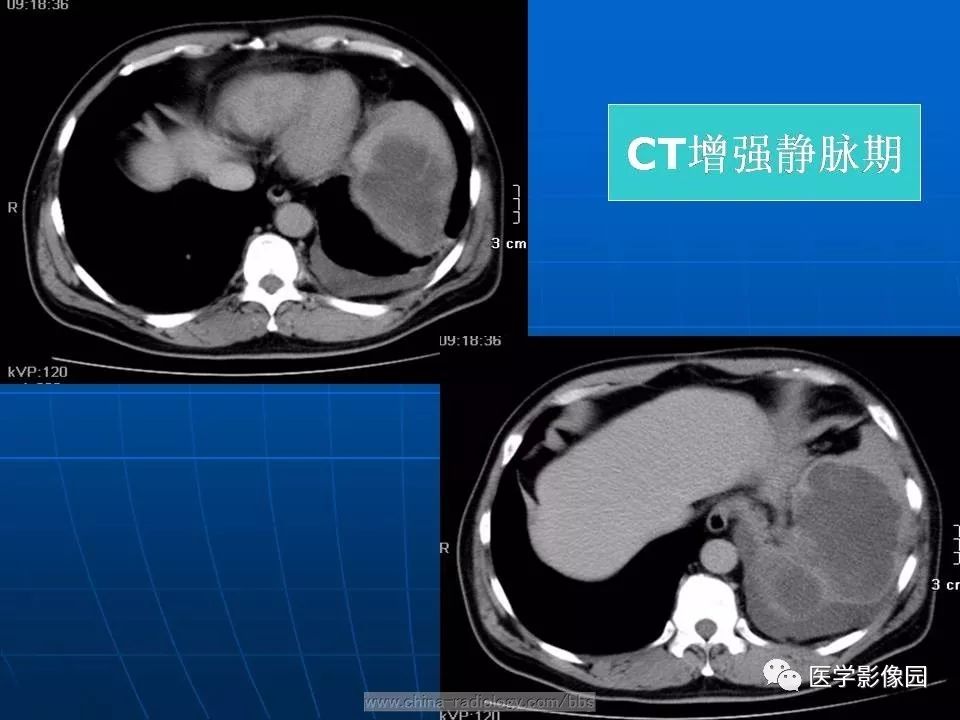 【病例】脾脏血管肉瘤1例CT影像表现