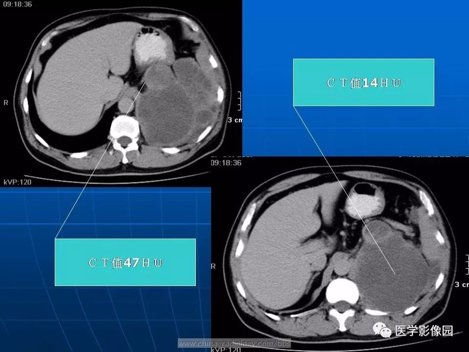 【病例】脾脏血管肉瘤1例CT影像表现