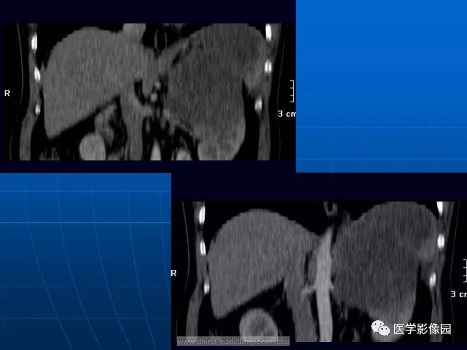 【病例】脾脏血管肉瘤1例CT影像表现