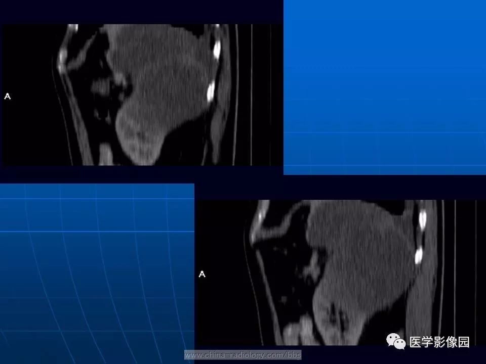 【病例】脾脏血管肉瘤1例CT影像表现