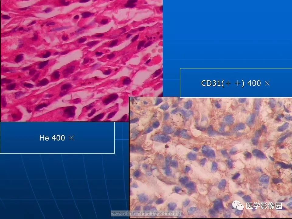 【病例】脾脏血管肉瘤1例CT影像表现