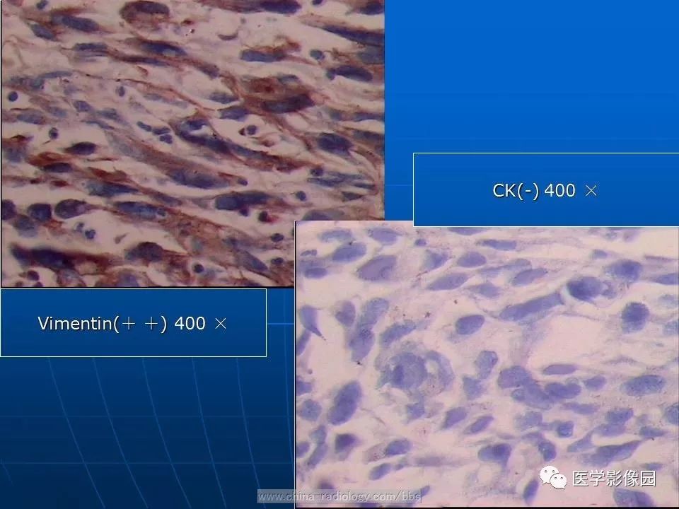 【病例】脾脏血管肉瘤1例CT影像表现