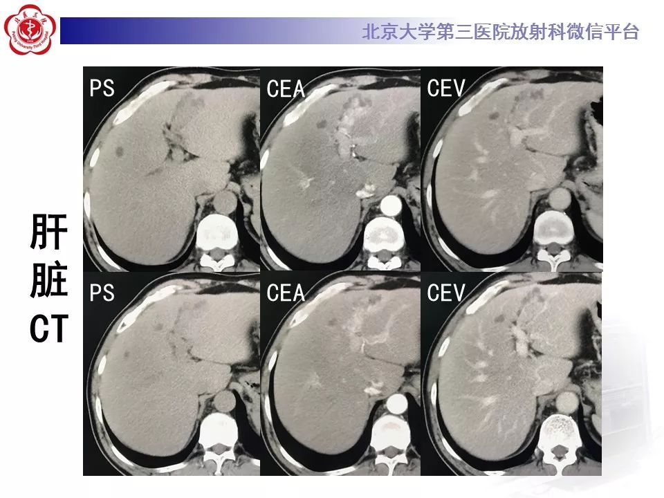 【病例】胆管导管内乳头状肿瘤1例CT及MR影像表现