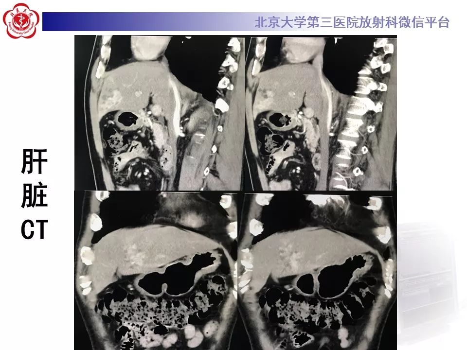 【病例】胆管导管内乳头状肿瘤1例CT及MR影像表现