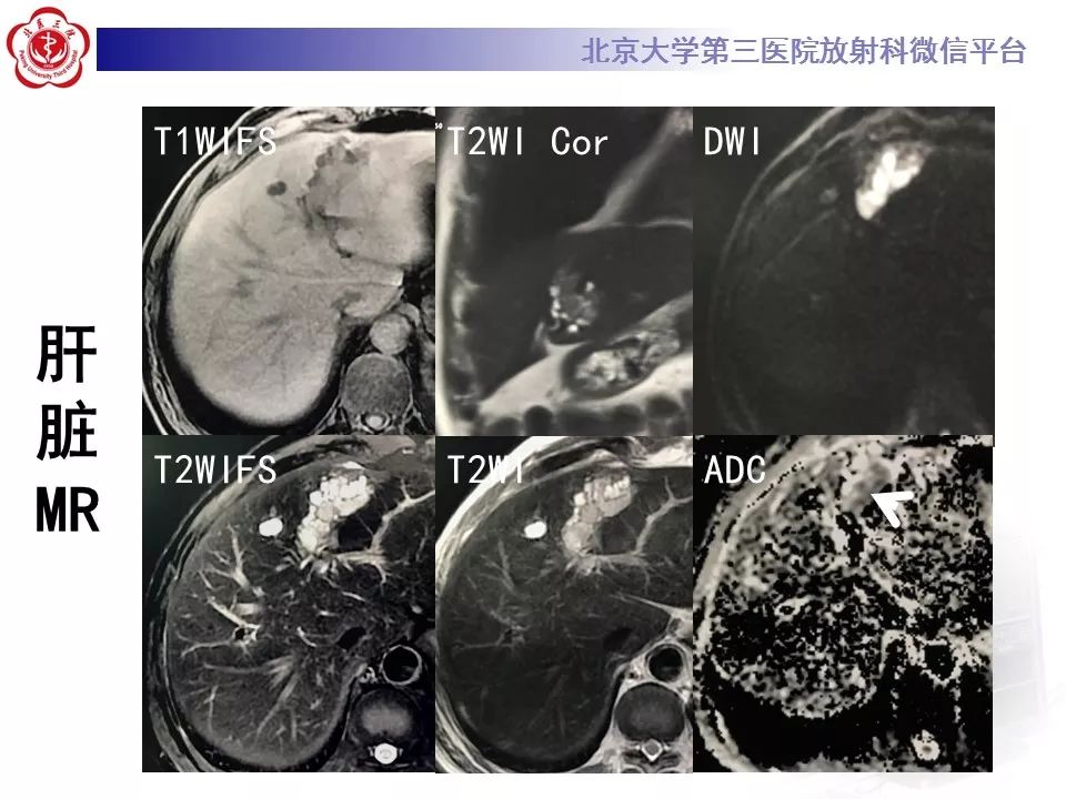 【病例】胆管导管内乳头状肿瘤1例CT及MR影像表现