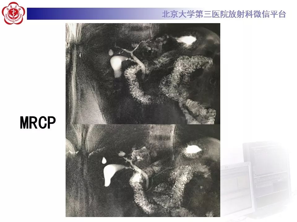 【病例】胆管导管内乳头状肿瘤1例CT及MR影像表现