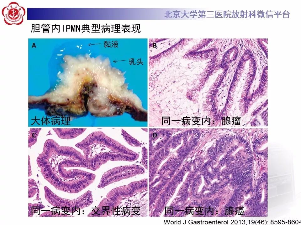 【病例】胆管导管内乳头状肿瘤1例CT及MR影像表现