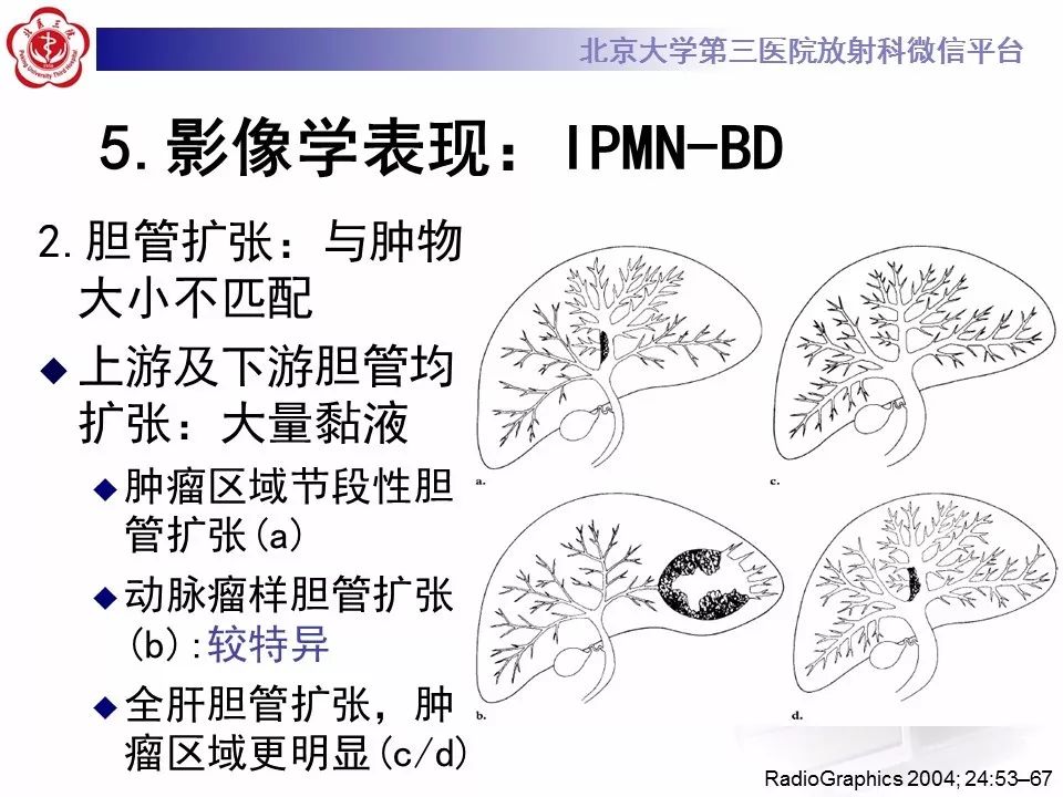 【病例】胆管导管内乳头状肿瘤1例CT及MR影像表现