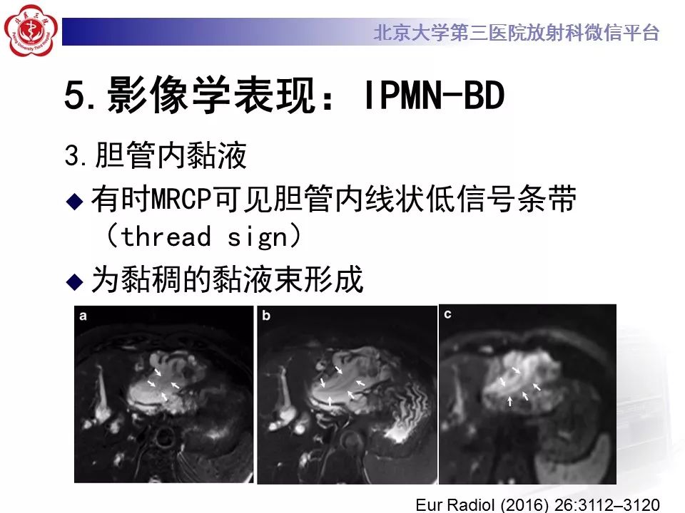 【病例】胆管导管内乳头状肿瘤1例CT及MR影像表现