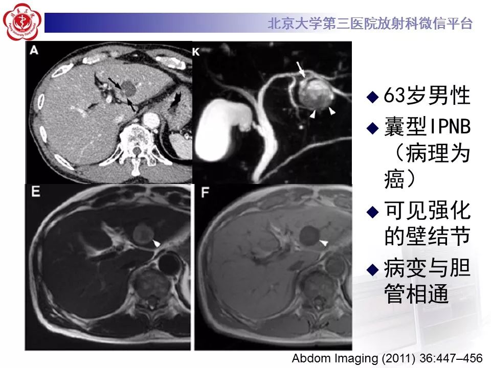 【病例】胆管导管内乳头状肿瘤1例CT及MR影像表现