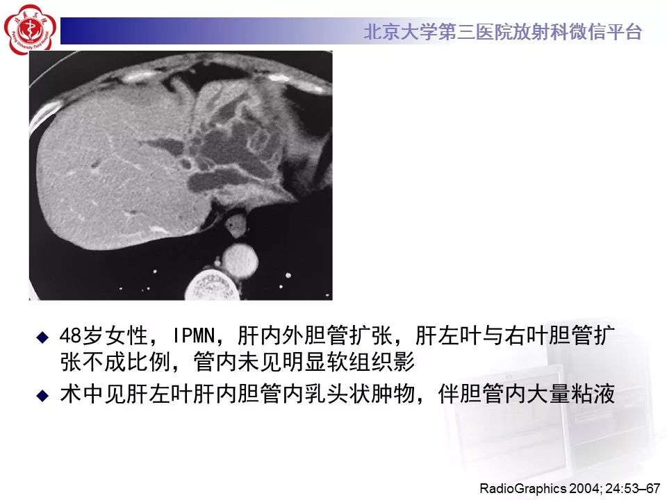 【病例】胆管导管内乳头状肿瘤1例CT及MR影像表现
