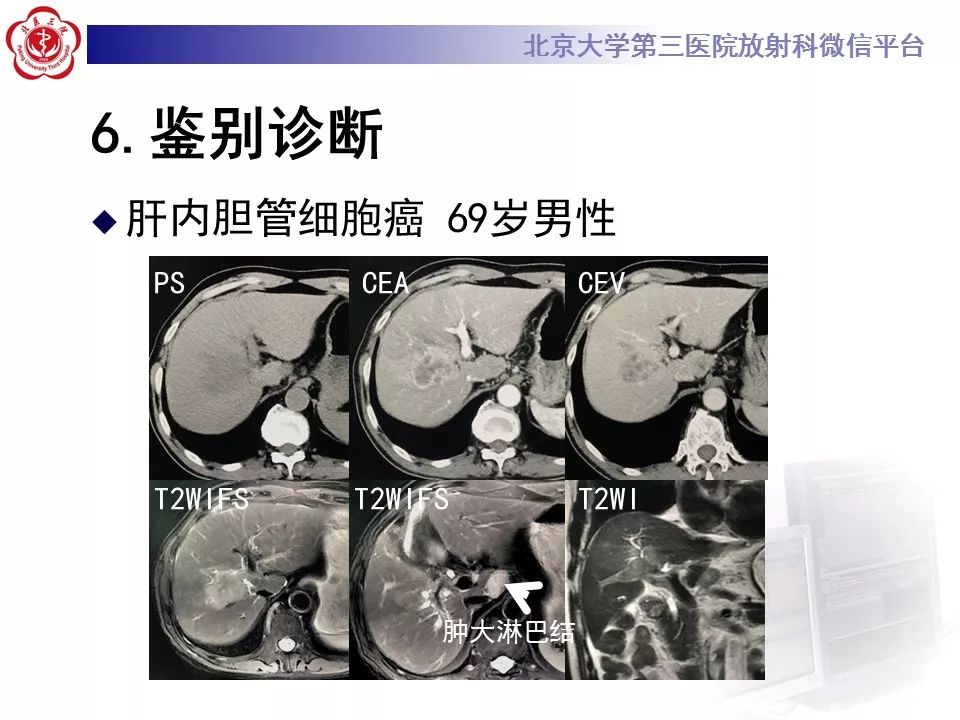 【病例】胆管导管内乳头状肿瘤1例CT及MR影像表现