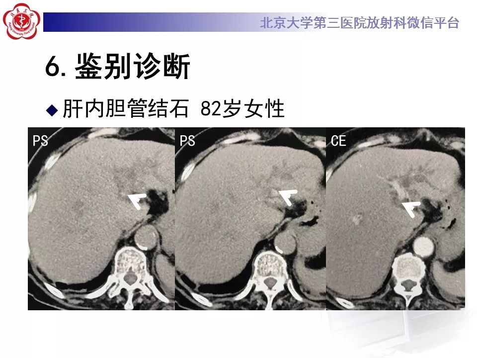 【病例】胆管导管内乳头状肿瘤1例CT及MR影像表现