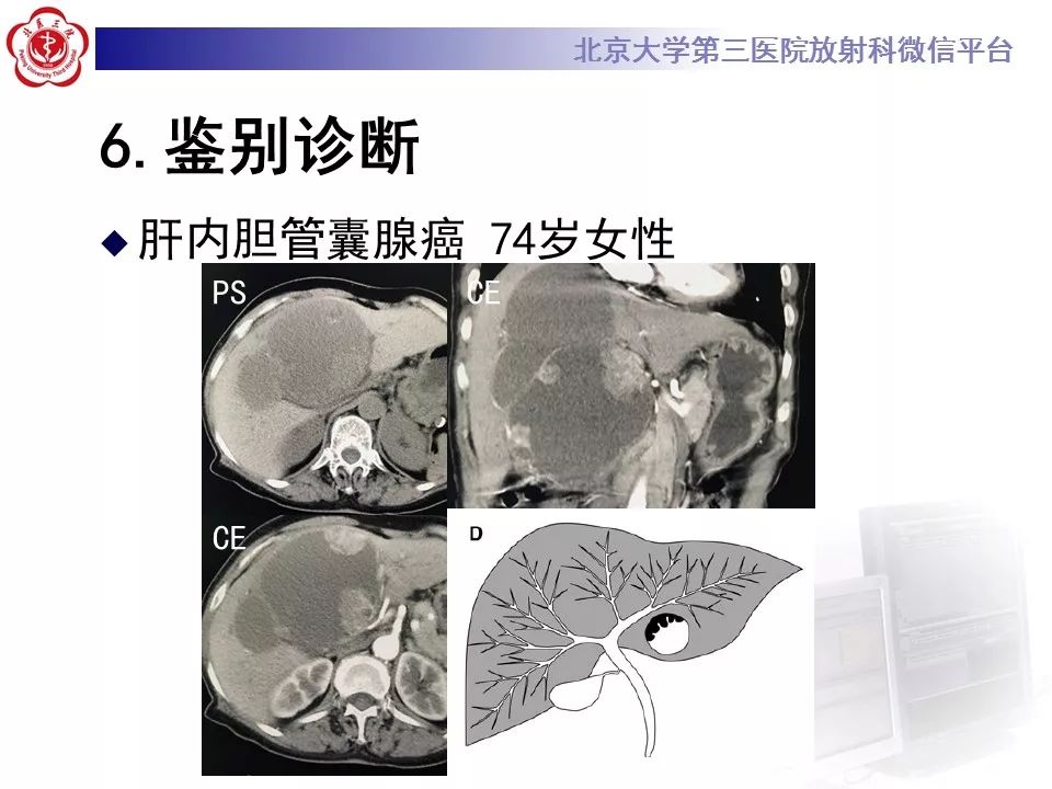 【病例】胆管导管内乳头状肿瘤1例CT及MR影像表现