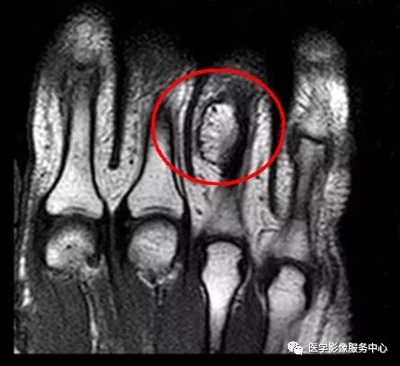 【病例】奇异性骨旁骨软骨瘤样增生1例X线MR 【病例】奇异性骨旁骨软骨瘤样增生1例X线MR