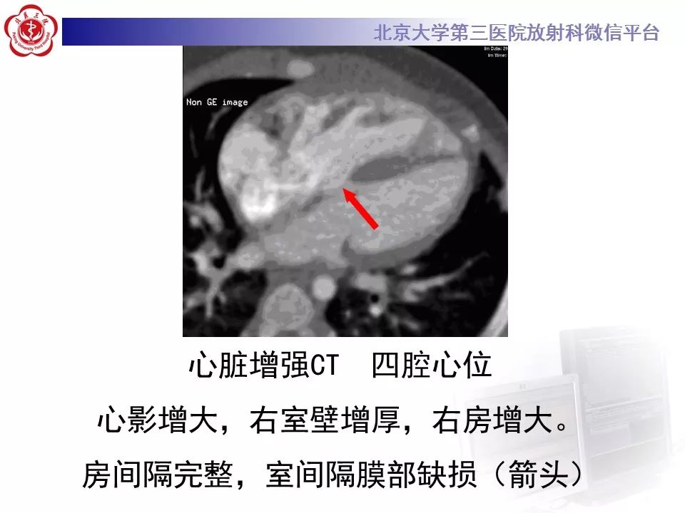 【病例】先天性心脏病—右室双出口1例CT