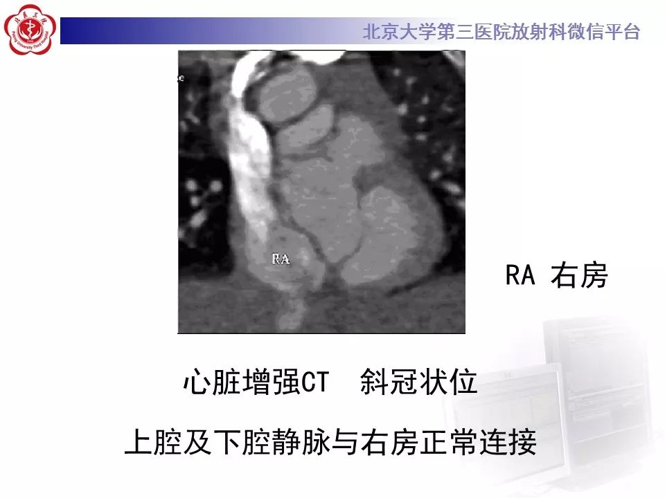 【病例】先天性心脏病—右室双出口1例CT