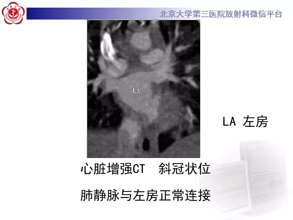 【病例】先天性心脏病—右室双出口1例CT