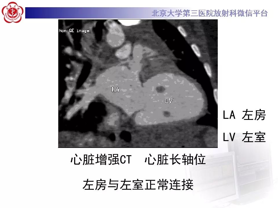 【病例】先天性心脏病—右室双出口1例CT