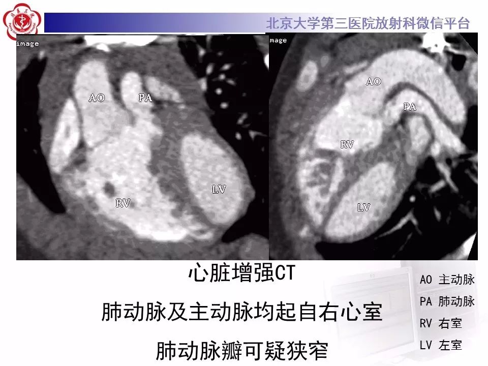 【病例】先天性心脏病—右室双出口1例CT