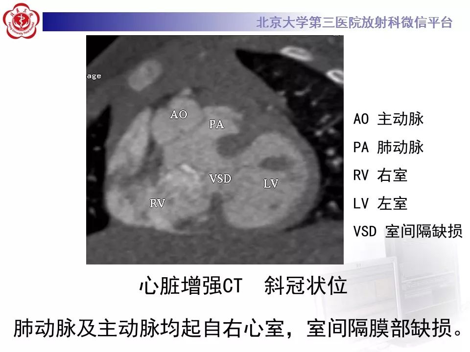 【病例】先天性心脏病—右室双出口1例CT