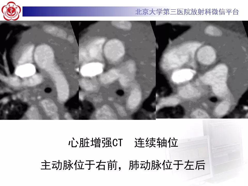 【病例】先天性心脏病—右室双出口1例CT