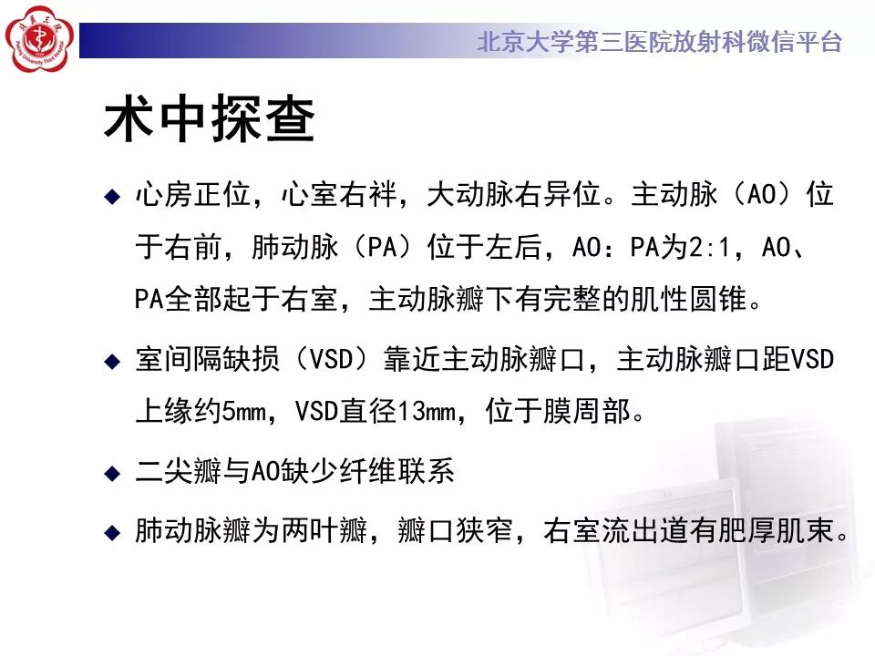 【病例】先天性心脏病—右室双出口1例CT