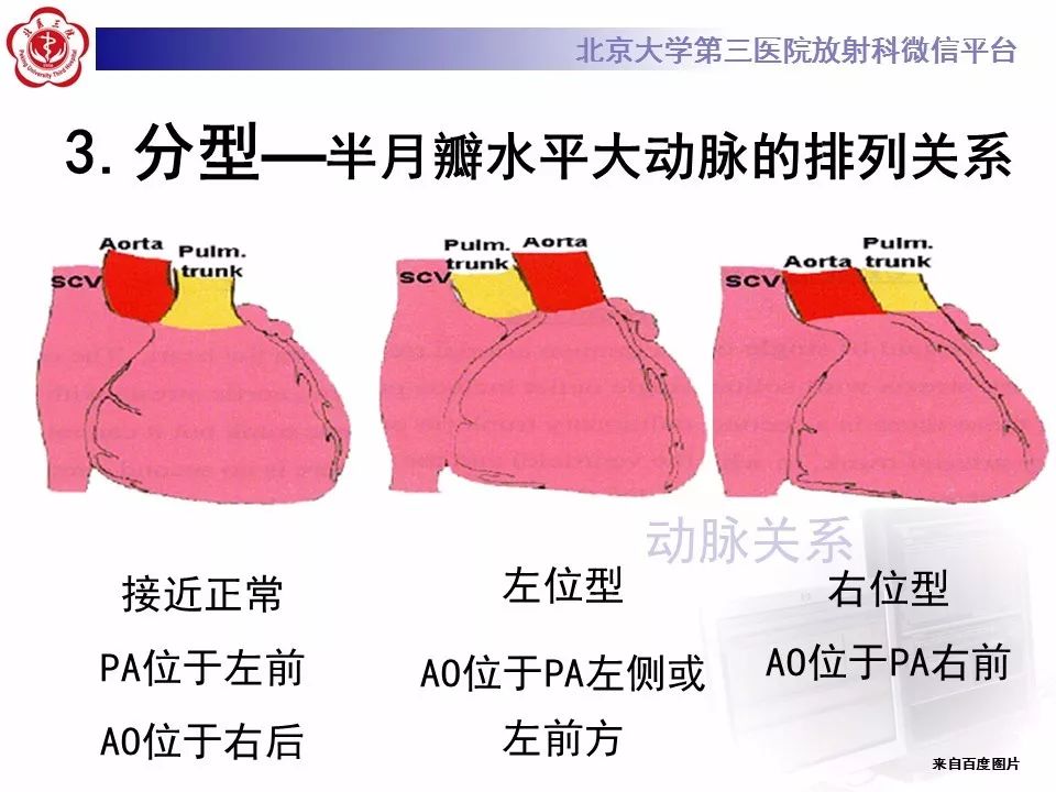 【病例】先天性心脏病—右室双出口1例CT