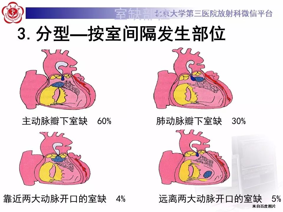 【病例】先天性心脏病—右室双出口1例CT