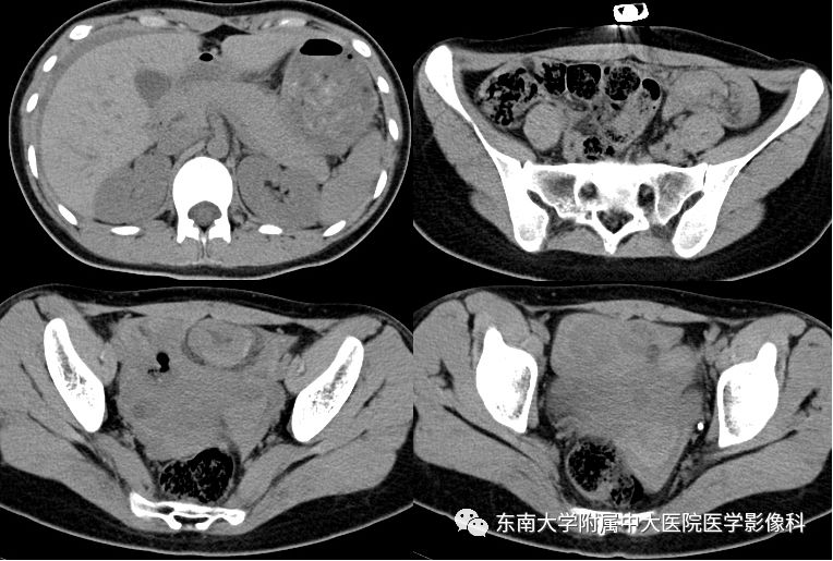 【病例】妇科急腹症3例随访读片