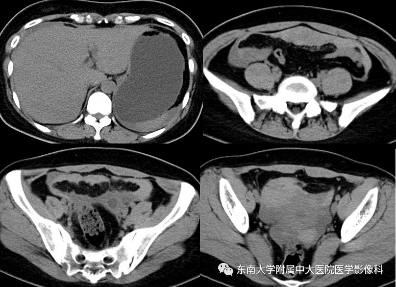 【病例】妇科急腹症3例随访读片