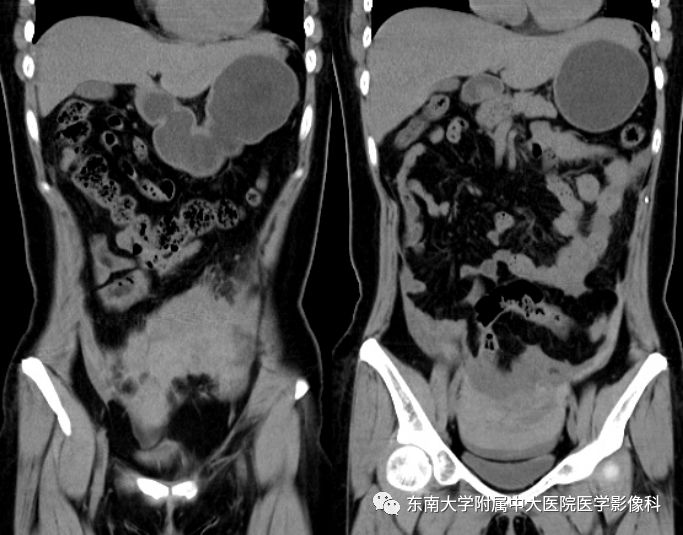 【病例】妇科急腹症3例随访读片