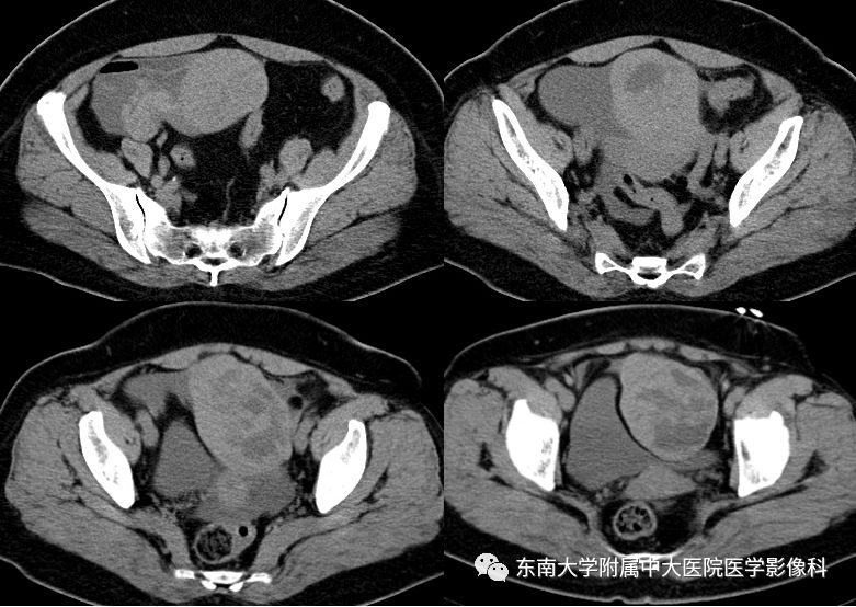 【病例】妇科急腹症3例随访读片