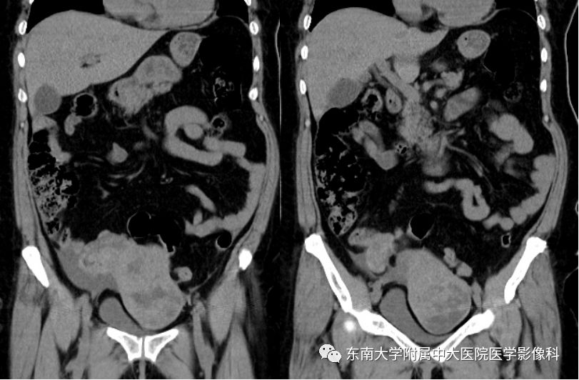 【病例】妇科急腹症3例随访读片