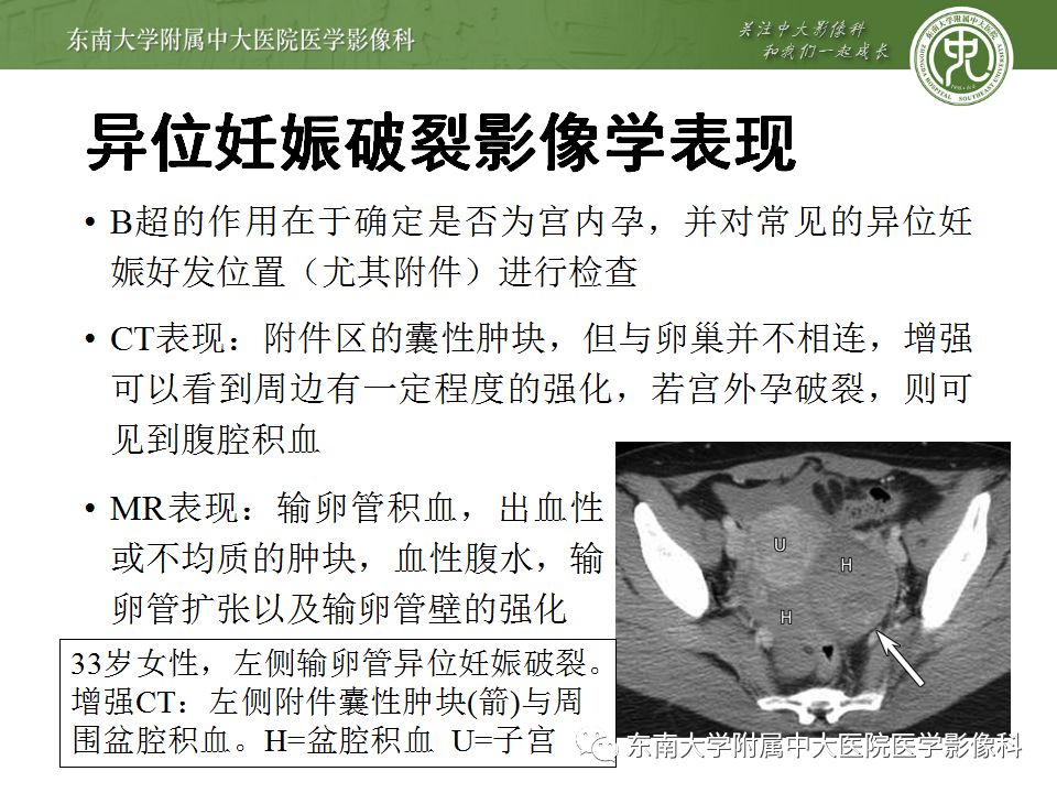 【病例】妇科急腹症3例随访读片