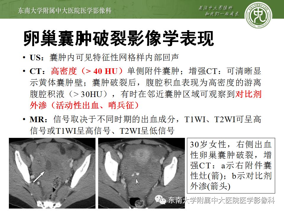 【病例】妇科急腹症3例随访读片