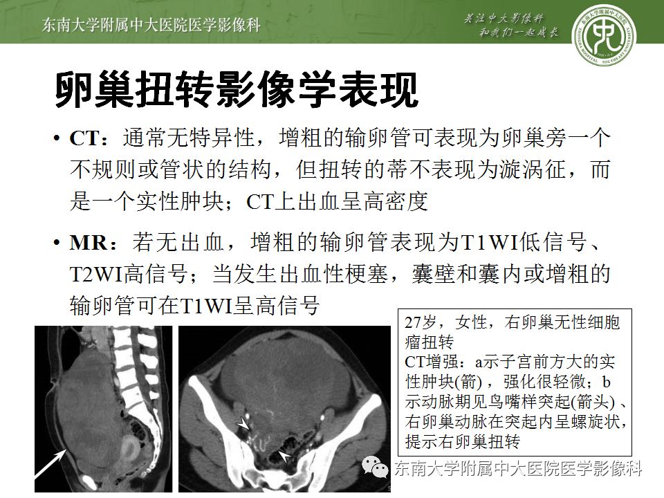 【病例】妇科急腹症3例随访读片