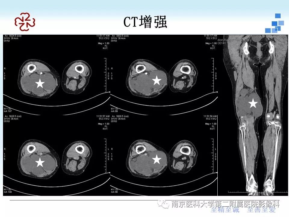 【PPT】脂肪肉瘤影像学表现